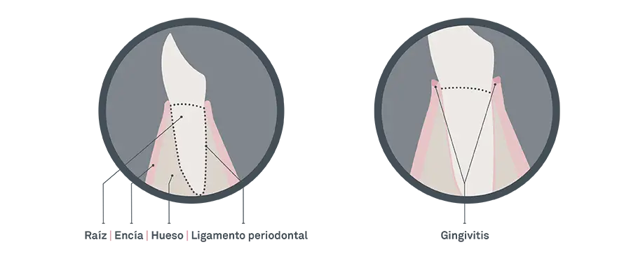 Problema periodontal gingivitis