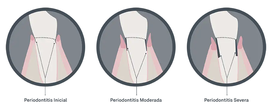 Problema periodontal periodontitis