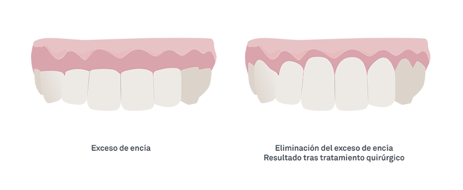 Exceso de encía