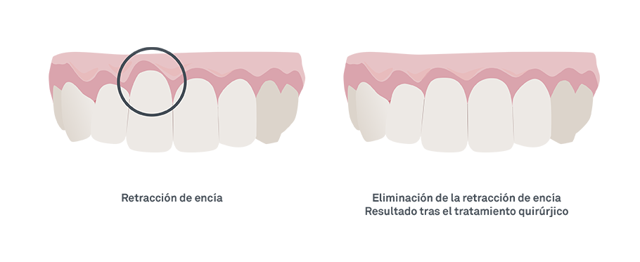 Retracción de encía