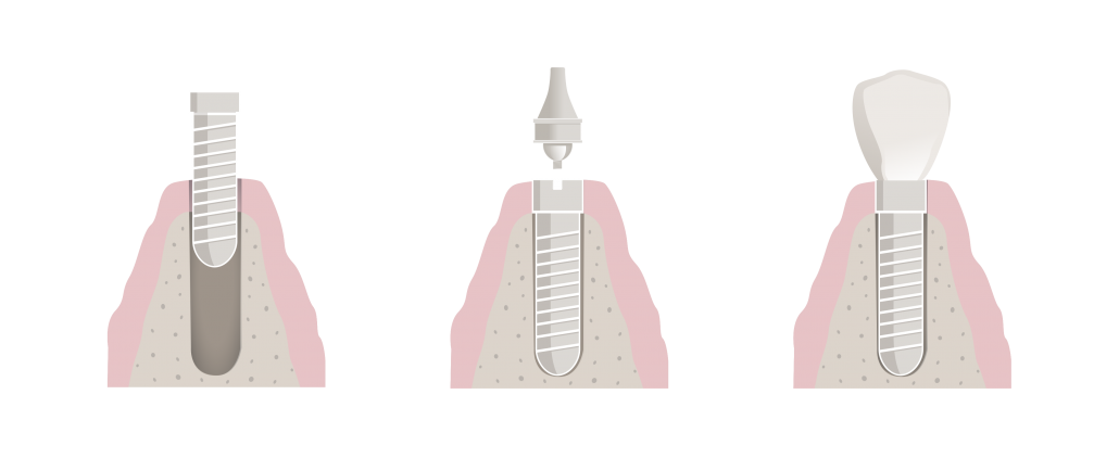 Ventajas de los implantes dentales